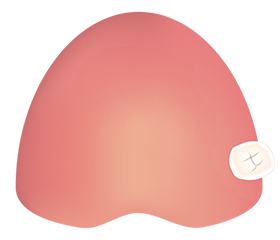 歯を全部抜く予定がある