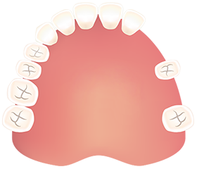 歯が飛び飛びで～3本抜けた