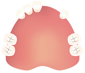 左右で4本以上抜けた