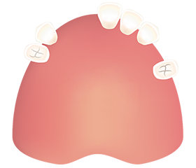歯が数本残っている