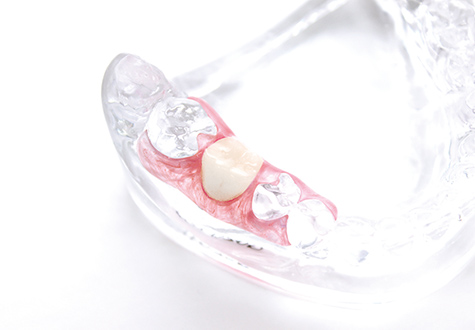 コンフォート義歯をご存知ですか？