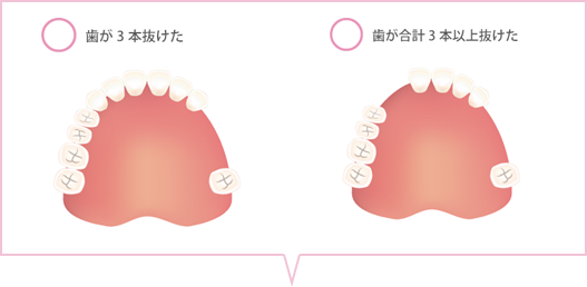 歯が3本抜けた、歯が合計3本以上抜けたのイラスト
