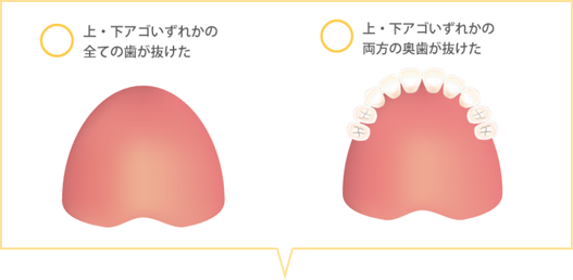 上・下アゴいずれかの全ての歯が抜けた、上・下アゴいずれかの両方の奥歯が抜けたのイラスト