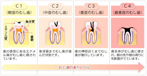 むし歯の進行表